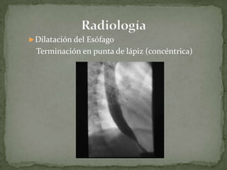 ►Dilatación del Esófago
Terminación en punta de lápiz (concéntrica)
 
