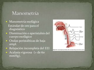  Manometría esofágica
Estándar de oro para el
diagnóstico
 Disminución o aperistalsis del
cuerpo esofágico
 Ondas peristálticas de baja
ampl.
 Relajación incompleta del EEI
 Acalasia vigorosa (> de 60
mmHg).
 