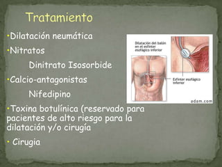 •Dilatación neumática
•Nitratos
Dinitrato Isosorbide
•Calcio-antagonistas
Nifedipino
•Toxina botulínica (reservado para
pacientes de alto riesgo para la
dilatación y/o cirugía
• Cirugia
 