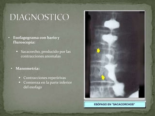 • Esofagograma con bario y
fluroscopia:
 Sacacorcho, producido por las
contracciones anomalas
• Manometria:
 Contracciones reperirivas
 Comienza en la parte inferior
del esofago
 