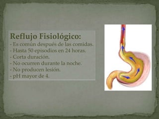 Reflujo Fisiológico:
- Es común después de las comidas.
- Hasta 50 episodios en 24 horas.
- Corta duración.
- No ocurren durante la noche.
- No producen lesión.
- pH mayor de 4.
 
