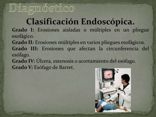 Clasificación Endoscópica.
Grado I: Erosiones aisladas o múltiples en un pliegue
esofágico.
Grado II: Erosiones múltiples en varios pliegues esofágicos.
Grado III: Erosiones que afectan la circunferencia del
esófago.
Grado IV: Úlcera, estenosis o acortamiento del esófago.
Grado V: Esófago de Barret.
 