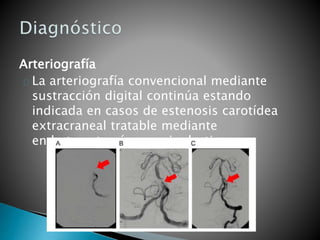 Arteriografía
La arteriografía convencional mediante
sustracción digital continúa estando
indicada en casos de estenosis carotídea
extracraneal tratable mediante
endarterectomía o angioplastia.
 