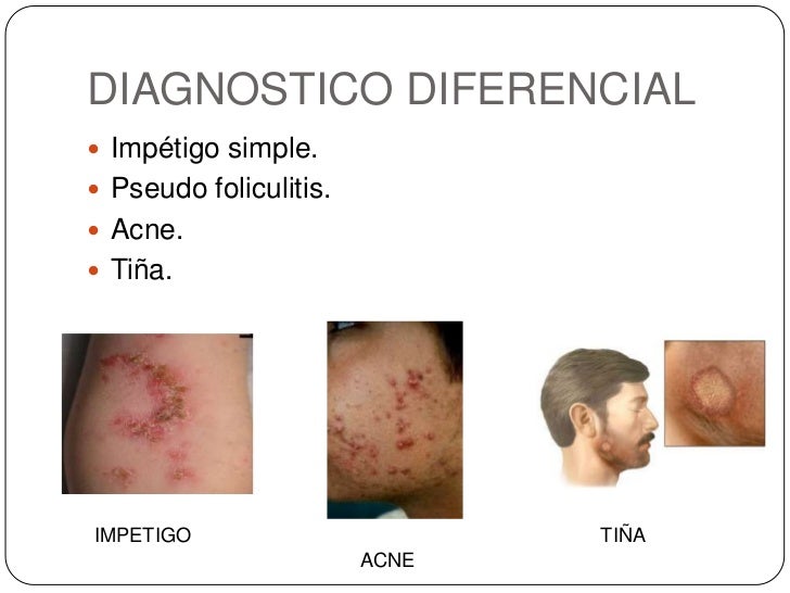 foliculitis cuero cabelludo expo foliculitis foliculitis cuero cabelludo expo foliculitis