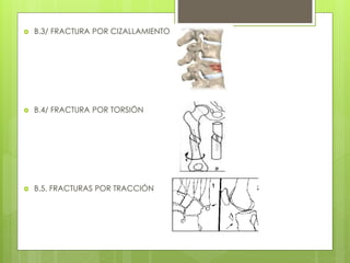  B.3/ FRACTURA POR CIZALLAMIENTO 
 B.4/ FRACTURA POR TORSIÓN 
 B.5. FRACTURAS POR TRACCIÓN 
 