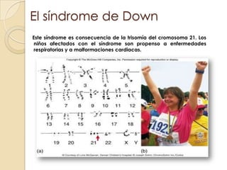 El síndrome de Down    Este síndrome es consecuencia de la trisomía del cromosoma 21. Los niños afectados con el síndrome son propenso a enfermedades respiratorias y a malformaciones cardiacas.