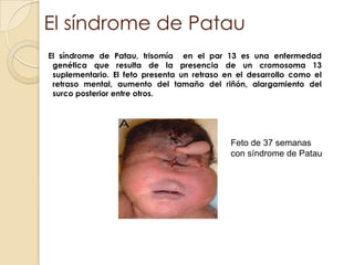 El síndrome de Patau   El síndrome de Patau, trisomía  en el par 13 es una enfermedad genética que resulta de la presencia de un cromosoma 13 suplementario. El feto presenta un retraso en el desarrollo como el  retraso mental, aumento del tamaño del riñón, alargamiento del surco posterior entre otros.Feto de 37 semanas  con síndrome de Patau