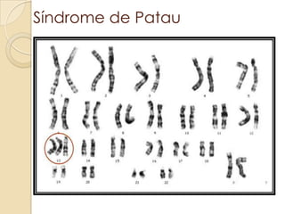 Síndrome de Patau