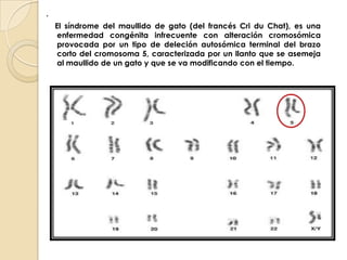.      El síndrome del maullido de gato (del francés Cri du Chat), es una enfermedad congénita infrecuente con alteración cromosómica provocada por un tipo de deleción autosómica terminal del brazo corto del cromosoma 5, caracterizada por un llanto que se asemeja al maullido de un gato y que se va modificando con el tiempo.