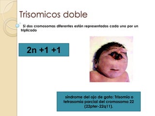 Trisomicos doble  Si dos cromosomas diferentes están representados cada uno por un triplicado 2n +1 +1 síndrome del ojo de gato: Trisomía o tetrasomía parcial del cromosoma 22 (22pter-22q11).