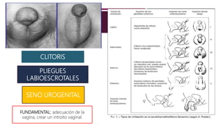 CLITORIS
SENO UROGENITAL
PLIEGUES
LABIOESCROTALES
FUNDAMENTAL: adecuación de la
vagina, crear un introito vaginal.
 