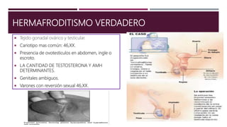 HERMAFRODITISMO VERDADERO
 Tejido gonadal ovárico y testicular.
 Cariotipo mas común: 46,XX.
 Presencia de ovotesticulos en abdomen, ingle o
escroto.
 LA CANTIDAD DE TESTOSTERONA Y AMH
DETERMINANTES.
 Genitales ambiguos.
 Varones con reversión sexual 46,XX.
 