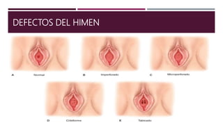 DEFECTOS DEL HIMEN
 