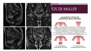 AGENESIA DE LOS CONDUCTOS DE MULLER
 Síndrome de Mayer-Rokitansky-Kuster-Hauser:
 Bolsa vaginal superficial de 2.5-5cm de profundidad.
 No existen útero, cuello uterino ni tercio superior de
la vagina.
 Ovarios normales.
 2-7% desarrolla endometrio funcional (dolor
abdominal cíclico).
 Es imposible la concepción tradicional.
 15-36% tiene anomalías asociadas (síndrome
MURCS).
 Considerarlas aquejadas de un síndrome complejo.
 