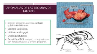 ANOMALIAS DE LAS TROMPAS DE
FALOPIO
 Orificios accesorios, agenesia, vestigios
quísticos embrionarios.
 Epooforo y paraoforo.
 Hidátide de Morgagni.
 Quistes paratubarios.
 Exposición al DES: trompas cortas y tortuosas,
con franjas arrugadas y orificios pequeños.
 