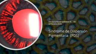 Síndrome de Dispersión
Pigmentaria (PDS)
DR ALEXANDER NARANJO N. R3
OFTALMOLOGÍA
 