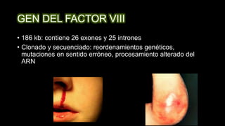 GEN DEL FACTOR VIII
• 186 kb: contiene 26 exones y 25 intrones
• Clonado y secuenciado: reordenamientos genéticos,
mutaciones en sentido erróneo, procesamiento alterado del
ARN
 