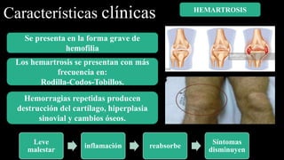 Características clínicas
Los hemartrosis se presentan con más
frecuencia en:
Rodilla-Codos-Tobillos.
Se presenta en la forma grave de
hemofilia
Hemorragias repetidas producen
destrucción del cartílago, hiperplasia
sinovial y cambios óseos.
Leve
malestar
inflamación reabsorbe
Síntomas
disminuyen
HEMARTROSIS
 