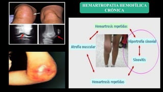 HEMARTROPATIA HEMOFÍLICA
CRÓNICA
 