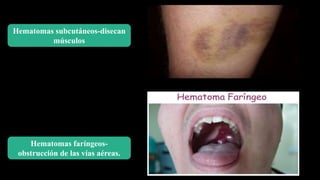 Hematomas subcutáneos-disecan
músculos
Hematomas faríngeos-
obstrucción de las vías aéreas.
 