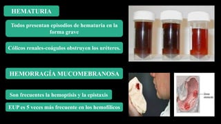 HEMATURIA
Todos presentan episodios de hematuria en la
forma grave
Cólicos renales-coágulos obstruyen los uréteres.
HEMORRAGÍA MUCOMEBRANOSA
Son frecuentes la hemoptisis y la epistaxis
EUP es 5 veces más frecuente en los hemofílicos
 