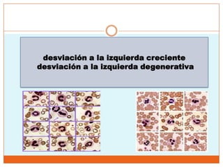 desviación a la izquierda creciente
desviación a la izquierda degenerativa
 