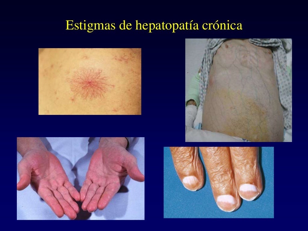 Hipertensión Portal