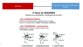 ISQUEMIA
Cambios en la polaridad y morfología de
la onda T
 