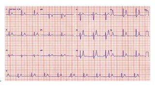 Onda T picuda que empieza después del
QRS
ISQUEMIA SUBENDOCARDICA
 