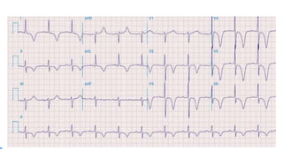 Onda T negativa
ISQUEMIA SUBEPICARDICA
 