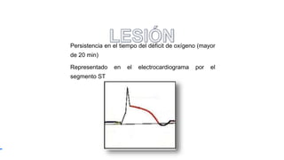 Persistencia en el tiempo del déficit de oxígeno (mayor
de 20 min)
Representado en el electrocardiograma por el
segmento ST
 