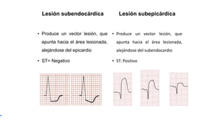 Lesión subendocárdica
• Produce un vector lesión, que
apunta hacia el área lesionada,
alejándose del epicardio
• ST= Negativo
Lesión subepicárdica
• Produce un vector lesión, que
apunta hacia el área lesionada,
alejándose del subendocardio
• ST: Positivo
 