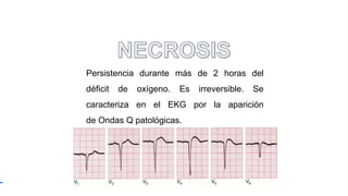 Persistencia durante más de 2 horas del
déficit de oxígeno. Es irreversible. Se
caracteriza en el EKG por la aparición
de Ondas Q patológicas.
 