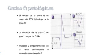 • El voltaje de la onda Q es
mayor del 25% del voltaje de la
onda R
• La duración de la onda Q es
igual o mayor de 0,04s
• Muescas y empastamientos en
la rama descendente o
ascendente de la onda Q
 