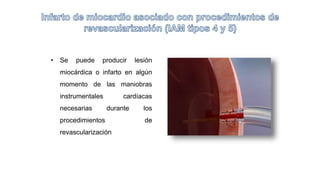 • Se puede producir lesión
miocárdica o infarto en algún
momento de las maniobras
instrumentales cardíacas
necesarias durante los
procedimientos de
revascularización
 