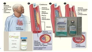 TRATAMIENTO ANTITROMBÓTICO PERIPROCEDIMIENTO
• Los inhibidores de la Glucoproteina IIb/IIIa actúan sobre la via final común de la activación
plaquetaria, los receptores de superficie plaquetaria para el fibrinógeno y factor de Von
Willebrand, que son precisamente los receptores de la glucoproteína IIb/IIIa.
La angioplastia facilitada consiste en la reparación percutánea
de la arteria causante del infarto de forma temprana (< 12 h),
rutinaria (no de rescate) y planeada (no urgente) en los
pacientes con SCAEST
Estas sustancias antitrombóticas van dirigidas a reducir los
riesgos y a aumentar la eficacia de la intervención.
 
