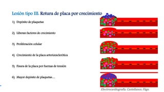 Lesión tipo III: Rotura de placa por crecimiento
1) Depósito de plaquetas
2) Liberan factores de crecimiento
3) Proliferación celular
4) Crecimiento de la placa arterioesclerótica
5) Fisura de la placa por fuerzas de tensión
6) Mayor depósito de plaquetas…
Electrocardiografía. Castellanos. Págs.
 