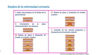 Estadios de la enfermedad coronaria
I. Lesión microscópica en la íntima de la
pared arterial
II. Crecimiento de la placa
arterioesclerótica. Sin síntomas
III. Rotura de placa y formación de
trombo no oclusivo. Angina
IV. Rotura de placa y formación de trombo
oclusivo
V. Oclusión de luz arterial progresiva y
formación de red arterial colateral
Electrocardiografía. Castellanos. Págs.
 