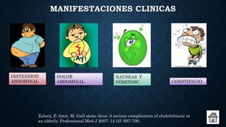 MANIFESTACIONES CLINICAS
DISTENSION
ABDOMINAL
DOLOR
ABDOMINAL
INTERMITENTE
NAUSEAS Y
VÓMITOSC
Zubair, Z; Amir, M. Gall stone ileus: A serious complication of cholelithiasis in
an elderly. Professional Med J 2007; 14 (4): 697-700.
CONSTIPACIO
N
 