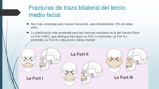 FRACTURAS DE LEFORT EPUB DOWNLOAD