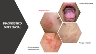 DIAGNÓSTICO
DIFERENCIAL
Herpes Simple
Eritema multiforme
Dermatosis por
medicamentos
Prurigo ampollar
 
