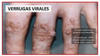 VERRUGAS VIRALES
Tumores epidérmicos
benignos muy frecuentes
Producidos por (HPV)
afectan la piel y mucosas
de los niños y...