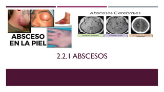 2.2.1 ABSCESOS
 