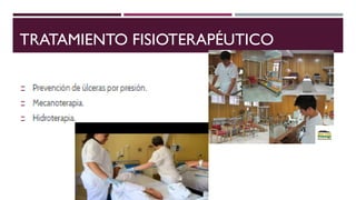 TRATAMIENTO FISIOTERAPÉUTICO
 