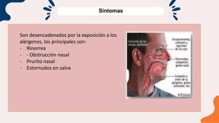 Síntomas
Son desencadenados por la exposición a los
alérgenos, los principales son:
- Rinorrea
- - Obstrucción nasal
- Prurito nasal
- Estornudos en salva
 