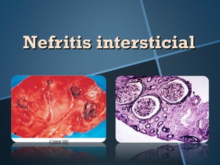 Nefritis intersticial
 