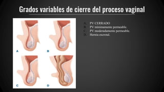Grados variables de cierre del proceso vaginal
A. PV CERRADO
B. PV mínimamente permeable.
C. PV moderadamente permeable.
D. Hernia escrotal.
 