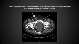 Tomografía computarizada que muestra una gran hernia inguinal derecha (flecha). También se
observa una pequeña hernia inguinal izquierda.
 