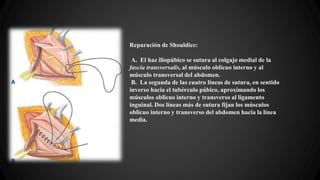 Reparación de Shouldice:
A. El haz iliopúbico se sutura al colgajo medial de la
fascia transversalis, al músculo oblicuo interno y al
músculo transversal del abdomen.
B. La segunda de las cuatro líneas de sutura, en sentido
inverso hacia el tubérculo púbico, aproximando los
músculos oblicuo interno y transverso al ligamento
inguinal. Dos líneas más de sutura fijan los músculos
oblicuo interno y transverso del abdomen hacia la línea
media.
 