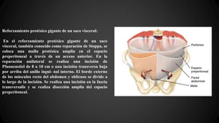 Reforzamiento protésico gigante de un saco visceral:
En el reforzamiento protésico gigante de un saco
visceral, también conocido como reparación de Stoppa, se
coloca una malla protésica amplia en el espacio
preperitoneal a través de un acceso anterior. En la
reparación unilateral se realiza una incisión de
Pfannenstiel de 8 a 10 cm o una incisión transversa baja
por arriba del anillo ingui- nal interno. El borde externo
de los músculos recto del abdomen y oblicuos se divide a
lo largo de la incisión. Se realiza una incisión en la fascia
transversalis y se realiza disección amplia del espacio
preperitoneal.
 